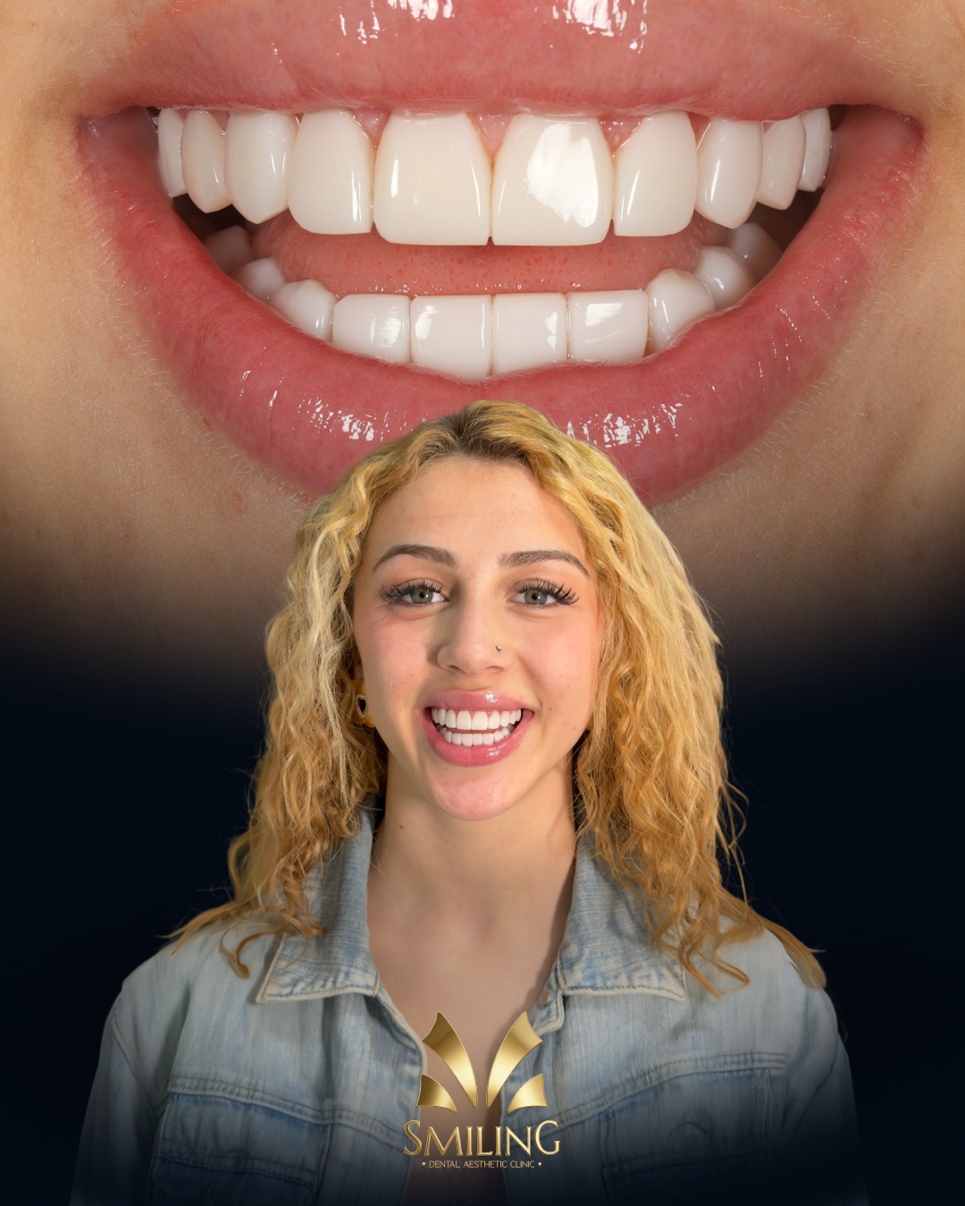 Sonrisa perfecta Smiling Clinics Barcelona